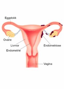 Endometrioseforandringer