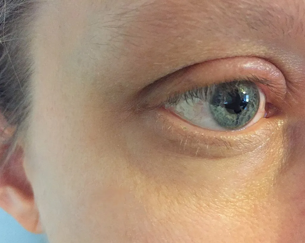 Pasient med hovent øyelokk
