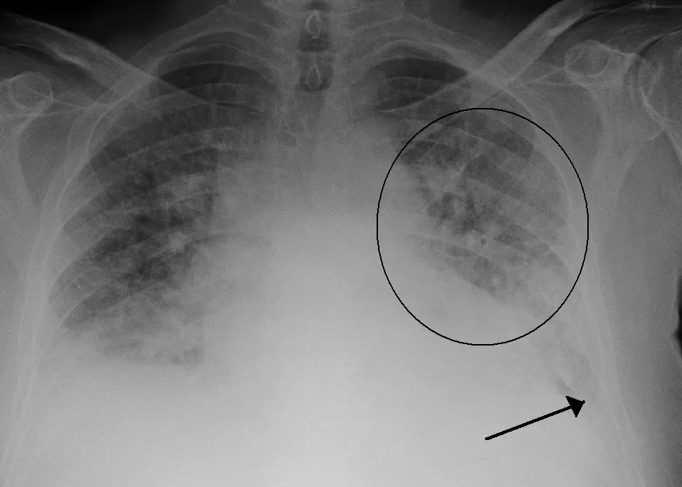 Røntgenbilde av vann i lungene, også kalt lungeødem
